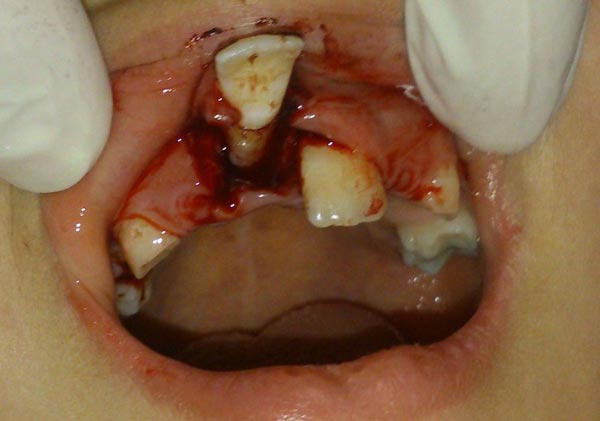 صدمات دندانی دکتر مصطفی محاوری
