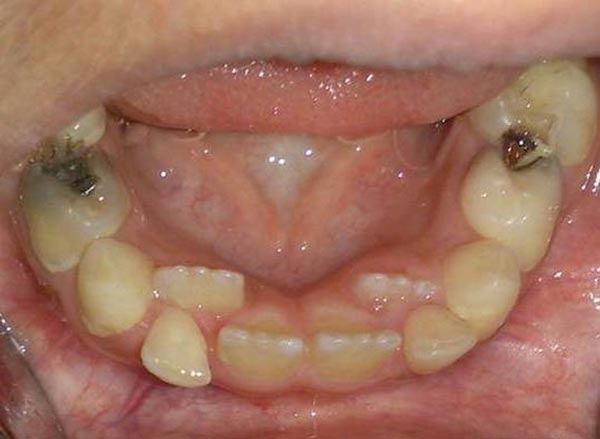 رویش دندانهای قدامی پائین در پشت دندانهای شیری دکتر مصطفی محاوری