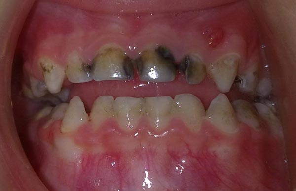 پوسیدگی دندانهای شیرخواران دکتر مصطفی محاوری