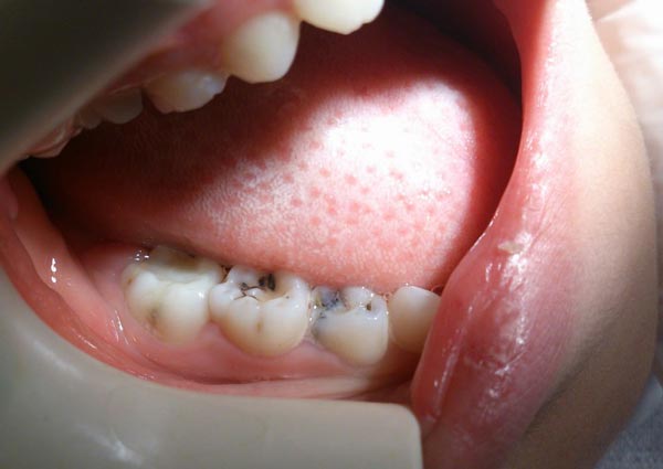  پوسیدگی در دندان کودکان دبستانی دکتر مصطفی محاوری