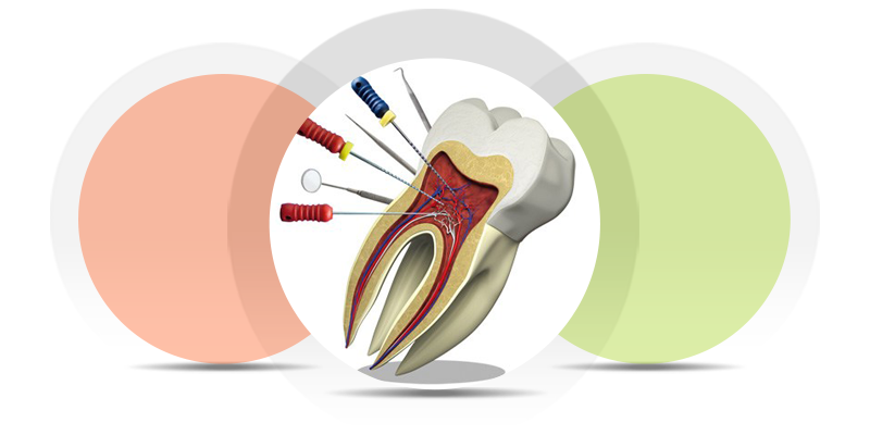معرفی خدمات دندان پزشکی دکتر مصطفی محاوری - درمان ریشه